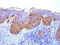 New treatment target for melanoma identified