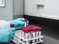 Blood test could detect kidney cancer up to 5 years earlier