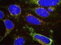 Ausspionieren der Essgewohnheiten von Zellen könnte die Krebsdiagnose erleichtern