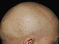 Neues Gen führt beim Menschen zu Haarlosigkeit