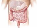 Obesity at a young age - a risk factor for early colorectal cancer