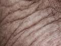 El estudio de biopsias de piel ofrece un potencial nuevo marcador diagnóstico para la Esclerosis Lateral Amiotrófica