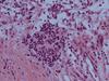 Tumoren auf Entzug: Aminosäuremangel lässt kindliche Tumoren schrumpfen