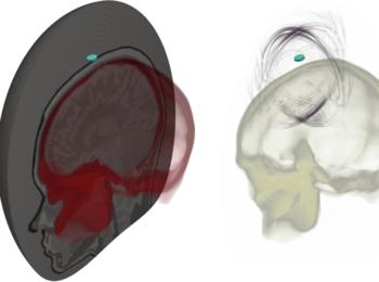 Izquierda: una malla de elementos finitos hexaédrica del cráneo y el cerebro. Derecha: Una instantánea de la simulación de ultrasonidos resultante. El disco azul en ambas imágenes representa la fuente de ultrasonidos.
