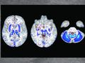 En estos escáneres cerebrales, las áreas azules indican las regiones con acumulación de hierro en individuos con dos copias del gen de riesgo de la hemocromatosis. Estas regiones también desempeñan un papel en el movimiento.