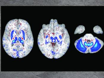 In diesen Hirnscans zeigen die blauen Bereiche die Regionen an, in denen sich bei Personen mit zwei Kopien des Hämochromatose-Risikogens Eisen ansammelt. Diese Regionen spielen auch bei der Bewegung eine Rolle.