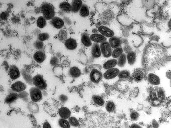 Pockenviren – hier unter dem Mikroskop – zählen zu den tödlichsten Krankheitserregern der Menschheitsgeschichte. Nicht ganz so gefährlich, aber dennoch beunruhigend ist der derzeitige Ausbruch der Affenpocken.