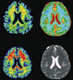 MRT-Bildgebung des Gehirns