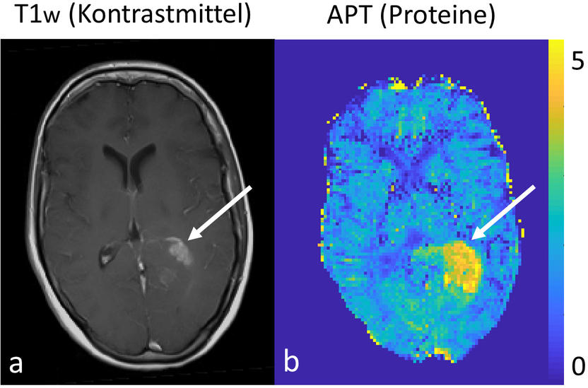 Protein content as a marker for response to therapy in brain cancer